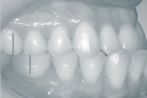 Mesial occlusion